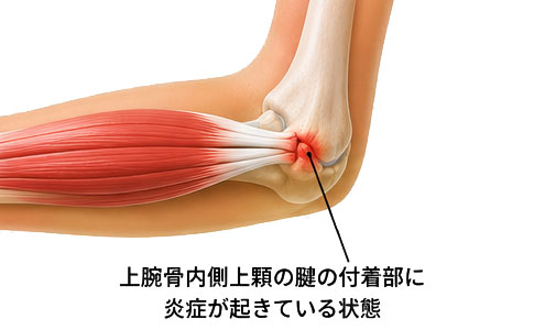 上腕骨内側上顆炎