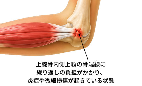 上腕骨内側上顆障害