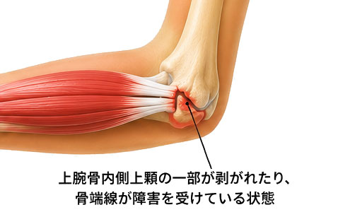 上腕骨内側上顆裂離・骨端線障害