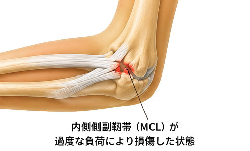 内側側副靱帯損傷