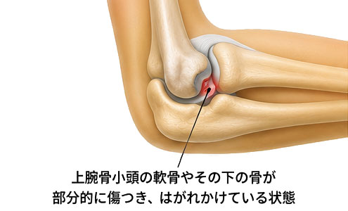 離断性骨軟骨炎