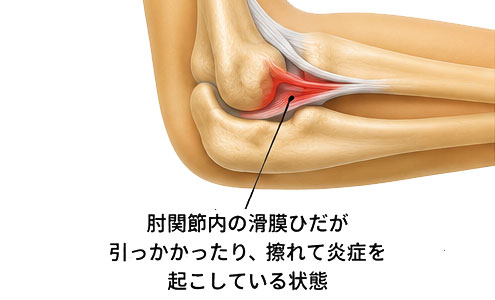 滑膜ひだ障害