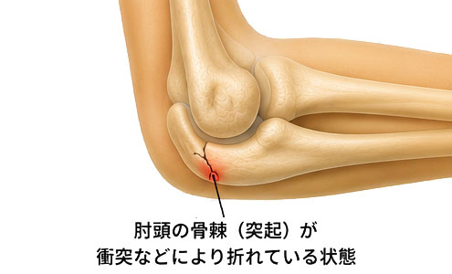 肘頭骨棘骨折
